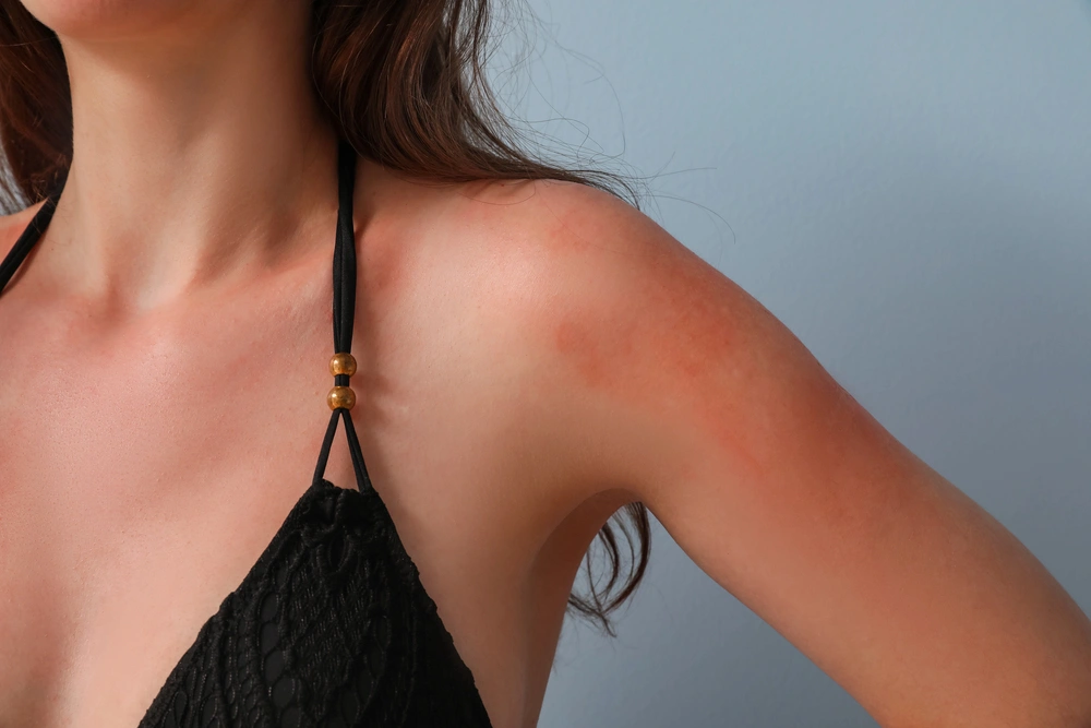 sunbed sessions woman overtanned with red sunburnt skin in bikini